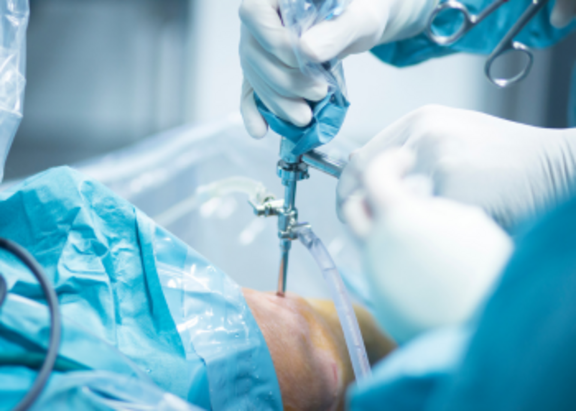 Arthroscopic ACL reconstruction